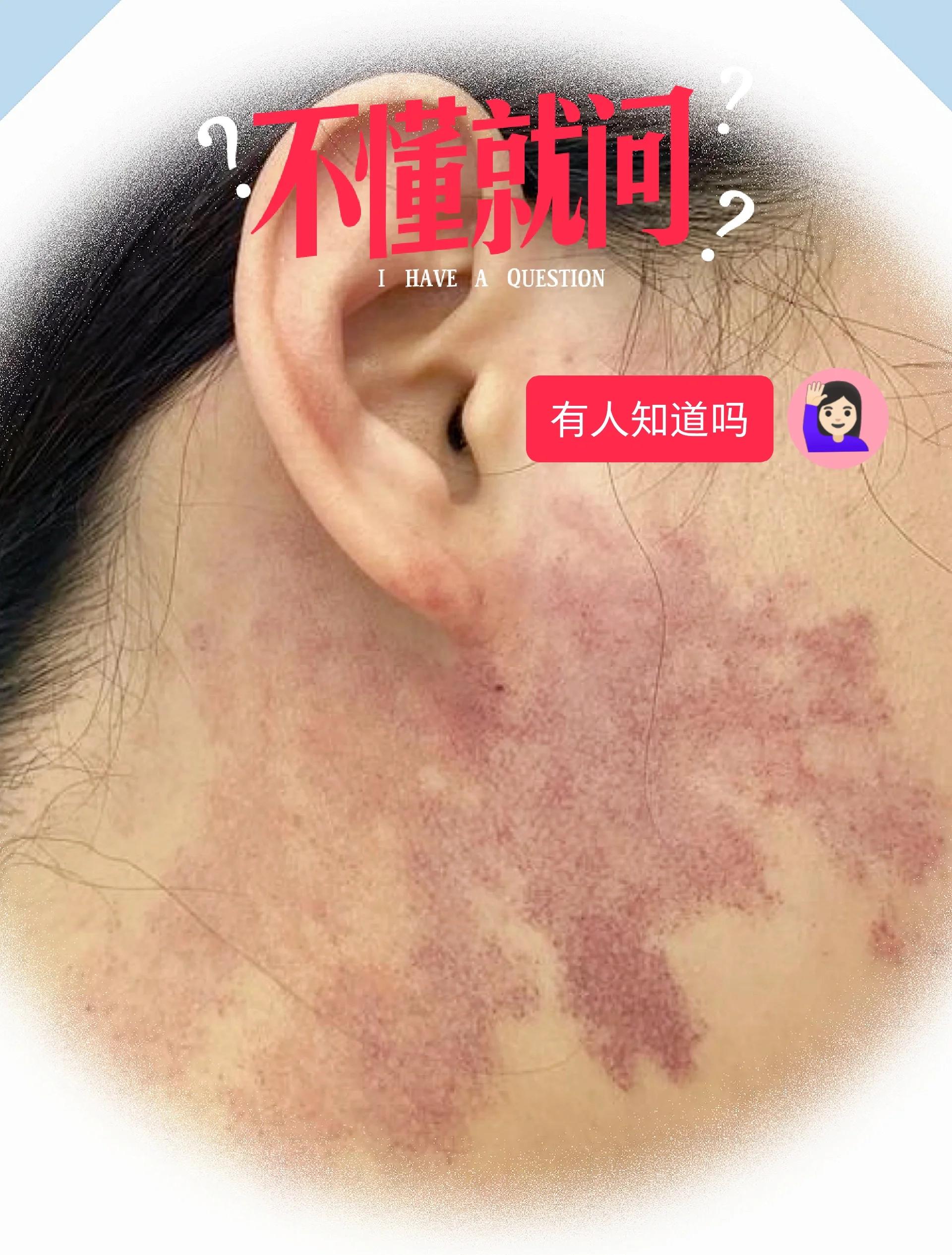 20種很好很有福氣的胎記胎記長在眉頭和屁股下面很好很有福氣