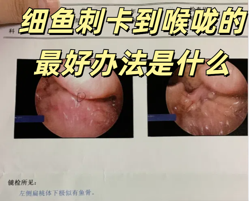 卡魚刺怎么辦最有效的方法