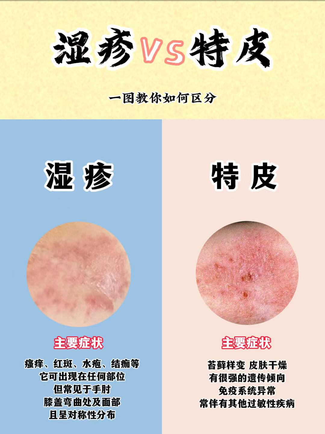 奶蘚是濕疹