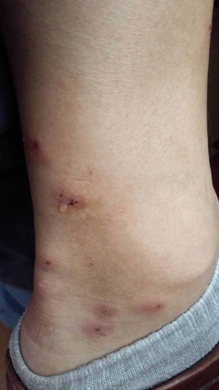 夢到蟲子咬我手指很疼